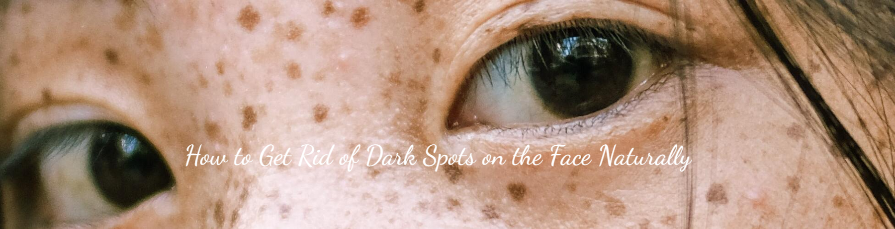 How to Get Rid of Dark Spots on the Face Naturally